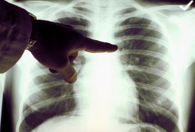 Presadili pluća pacijentu obolelom od kovida 19